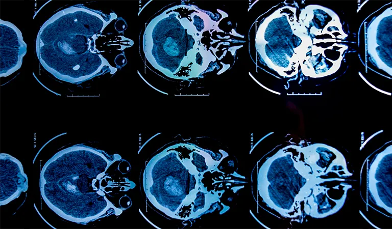 Qué es un aneurisma cerebral